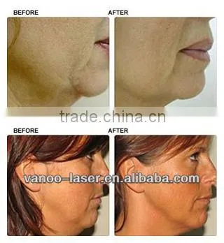 spa salon use skin tightening aesthetic equipment