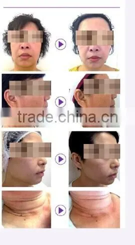 reduction of wrinkle, dark color, puffy skin remage device