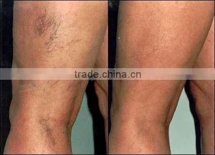 2016 Personal use 1064 long pulsed nd yag laser hair removal machine