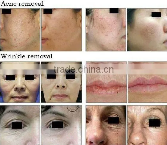 S0-07 Oxygen injection treatment Skin Oxyen Spray Beauty Machine