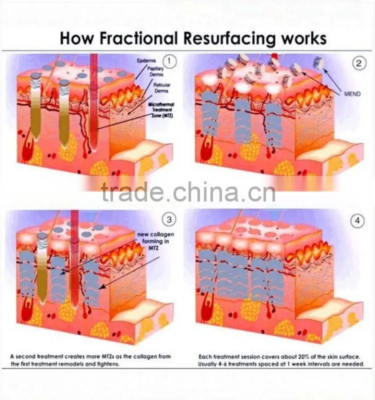 2015 beauty eauipment new co2 laser ablative ablative skin resurfacing, Vagina Tightening laser, Co2 Laser