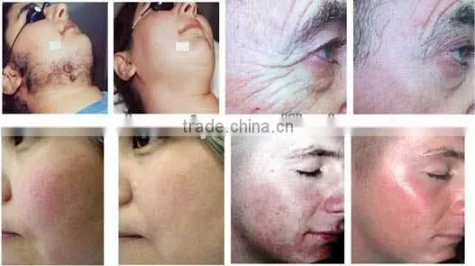 hair removal skin whitening wrinkle cure - ipl A008 beauty equipment with xenon lamp