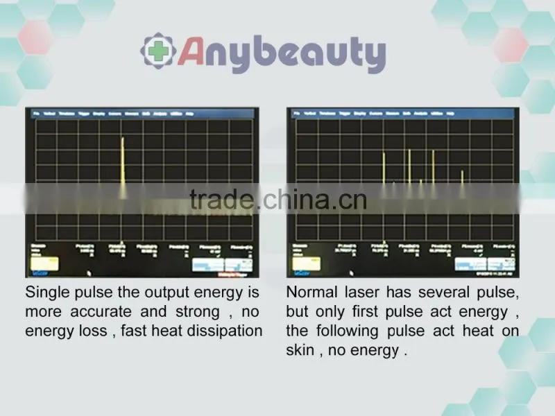 carbon peeling treatment/tatoo removal machine carbon peeling treatment