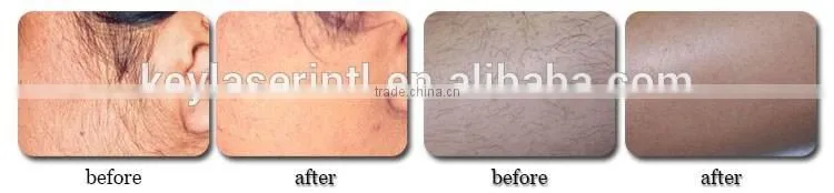 latest beauty equipmentipl shr laser hair removal machines shr ipl hair removal for sale with two handles
