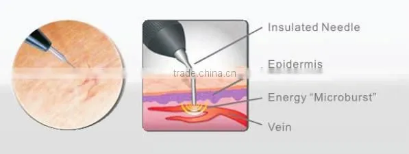 Spider Vein Removal machine Beauty Salon / Clinic/ Spa use Machine