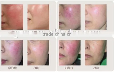 Manufacturer Supply Vascular / Veins / Spider Veins Removal 980nm / 980nm Diode Laser Medical Price Spider Vein Removal Machine