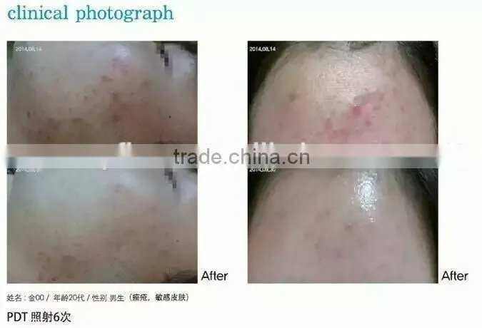 2016 hot Deep clean Skin whitening led facial mask / led pdt / led light therapy