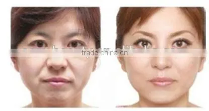High technology Fractional rf radio frequency machine for face and body face lifting -F-TJ03
