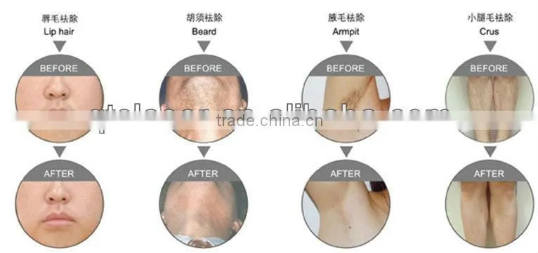 Professional painless hair removal, skin rejuvenation 808nm diode laser machine