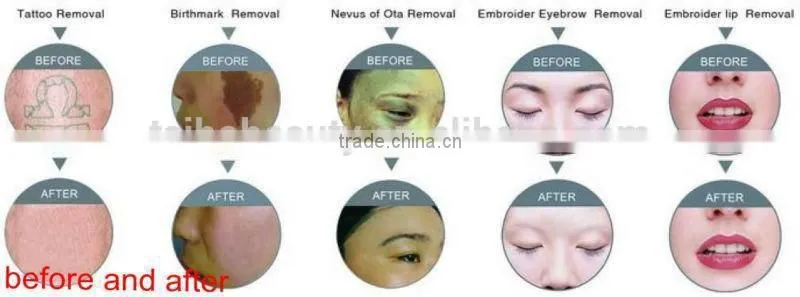 2015 Chrismas promotion USd1200!! ND yag laser tattoo remover portable / Mini home use tattoo removal nd yag laser