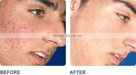 E-Light ipl + radio frequency photo beauty epilator