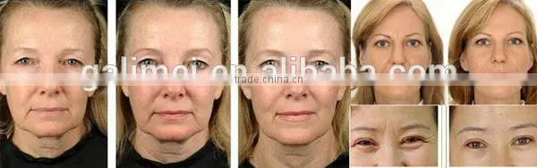 High quality PDT led machine/led bio light facial beauty device
