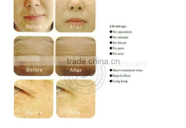 hotsale multipolar radio frequency rf facial machine FG-RF05