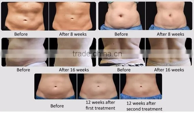 Body slimming fat freezing cavitation cryo lipo machine
