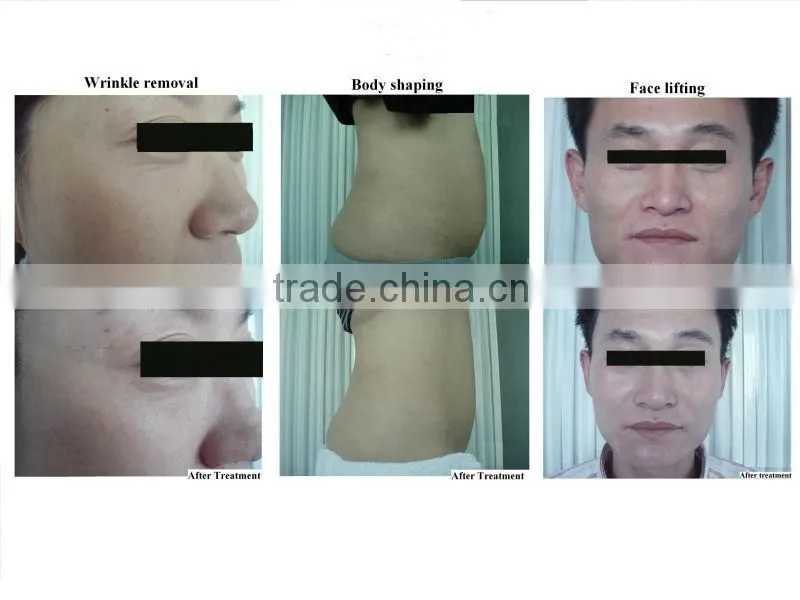 cellulite reduction vacuum slimming beauty machine