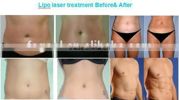 2016 hot in USA Newest Lipo laser 14 pads 650nm 940nm lipo laser slimming machine for sale / laser slimming lipo price
