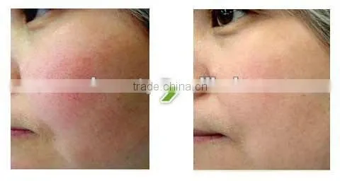 IPL Hair Removal, Permanent Hair Reduction