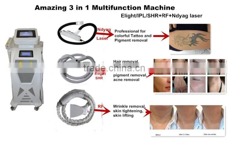 Elight rf+ipl solon use face lift machine for vascular/wrinkle/acne removal