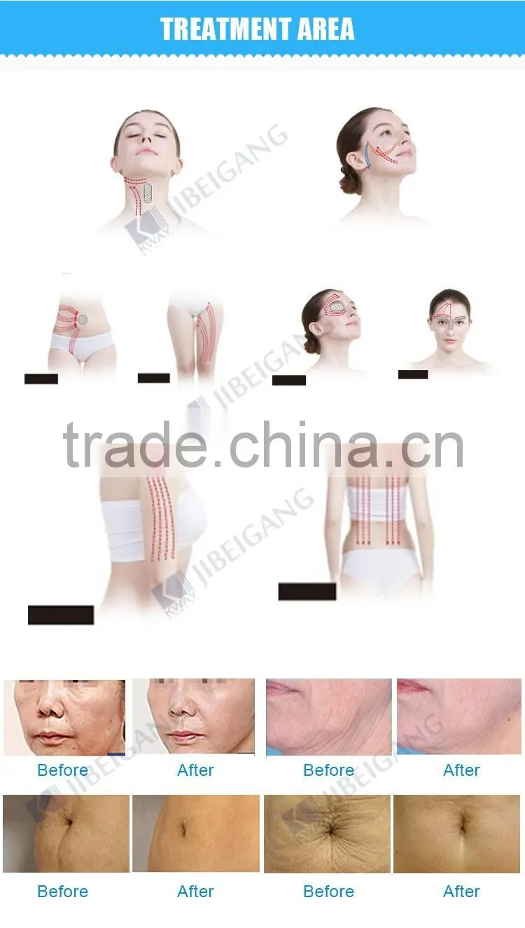 ce approval medical grade magic pot rf wrinkle removal machine