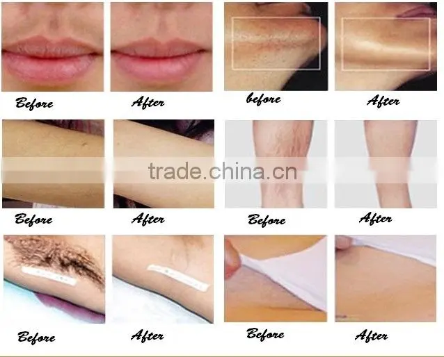 hair removal equipment / home hair removal / types of laser hair removal machine
