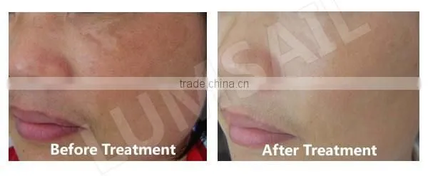 LED Phototherapy Lamp/Beauty Salon Infrared Lamp/Facial skin acne/skin tightening/skin rejuvenation/hair loss treatments