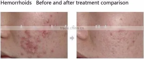New arrival! microdermabrasion machine face lift at home with radio frequency facial machine