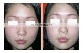 Beauty supply skin tightening thermagic rf machine