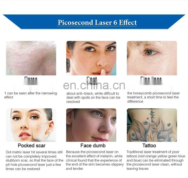 mole removal picsecond removal tattoo machine factory price to sell