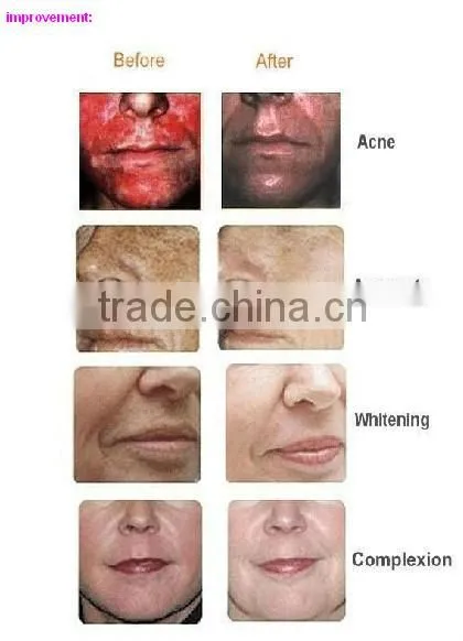 Water Oxygen Injection Acne Treatment Device