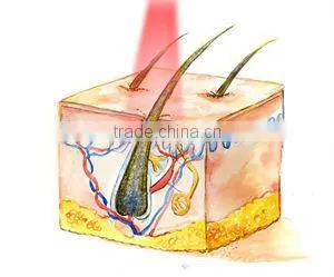 Patent contact cooling tips ICE SHR technology hair removal aesthetic equipment ICE 1