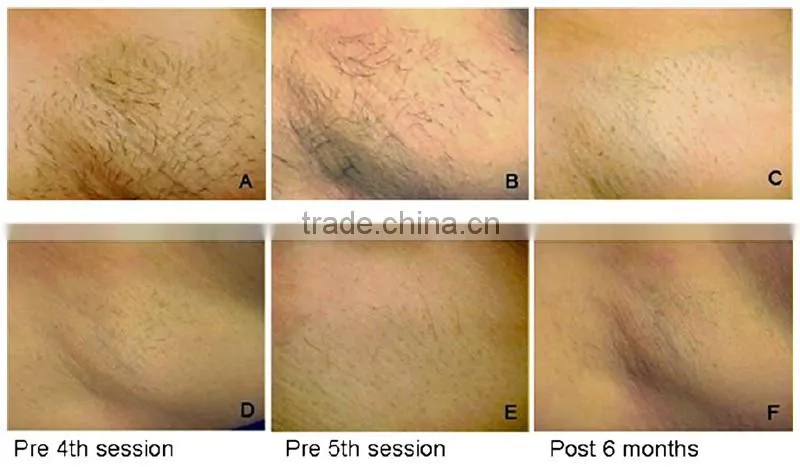 Top seller! depilacion laser 808 Diode body hair removers for man/ diode laser 808nm depilator