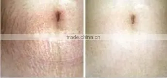 2015 Titanium galvanic derma roller microneedle L005 540 nm