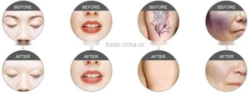 Laser Mole Removal Tattoo Removal Beauty Equipment