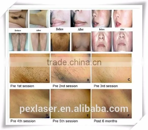 Laser Type and Stationary Style Diode Hair removal laser