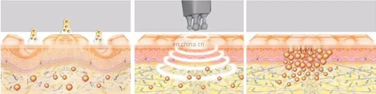 hot sale rf fast vacuum cavitation kim 8 slimming system
