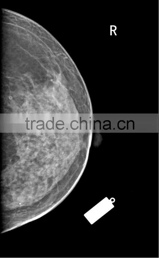 Digital Mammography System