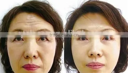 mikrotubuler diode bar/808nm diode laser hair removal