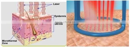 USA RF tube fractional co2 laser skin resurfacing