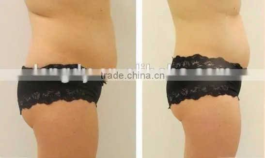 2016 liposonix hifu slimming equipment / liposonix LANGDI ORIGINAL FACTORY