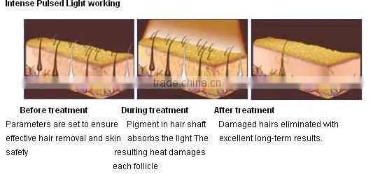 hair removal skin whitening wrinkle cure - ipl A008 beauty equipment with xenon lamp