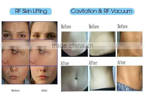 2017 Cavi RF machine RFloss weight ultrasonic fat burning slimming cellulite best ultrasound cavitation machine slimming machine