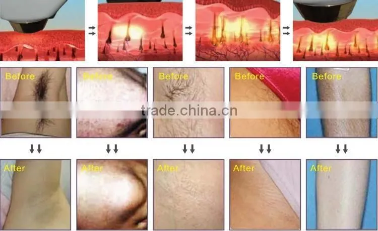 Latest Technology 808nm diode laser professional hair removal machine