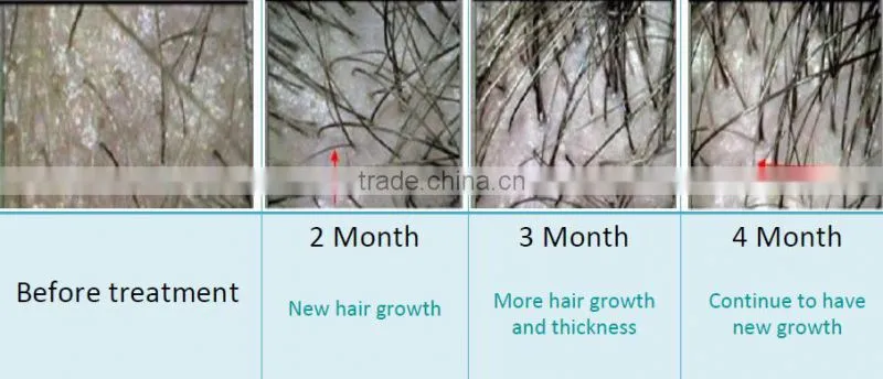 led and laser hair treatment hair regrowth treatment machine