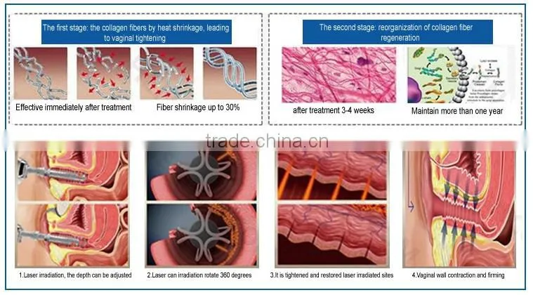 hotsale CO2 fractional laser vaginal tightening device