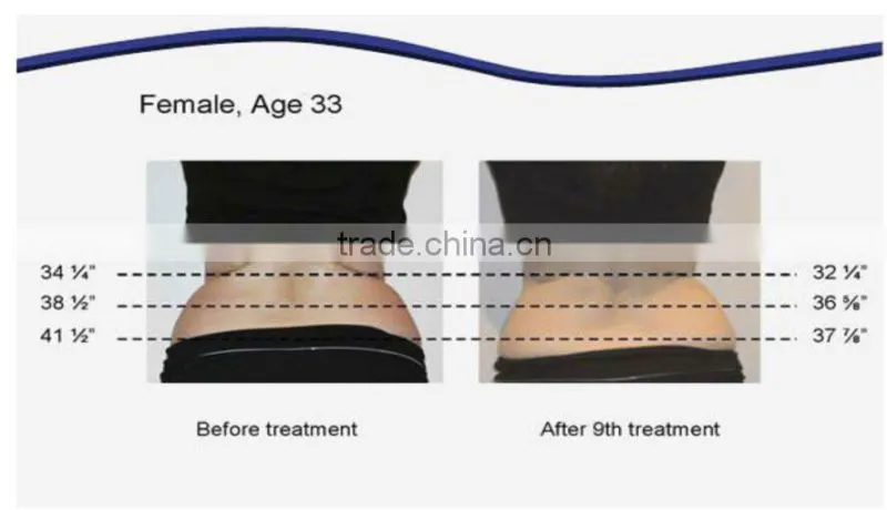 guangzhou supplier lipo laser slimming machine for reduce fat