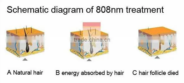 2015 New arrival Most advanced 808nm diode laser /diode laser hair removal/ diode laser 808