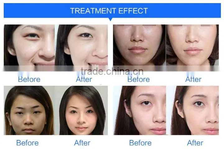 vacuum theory water hydro dermabrasion professional skin beauty machine