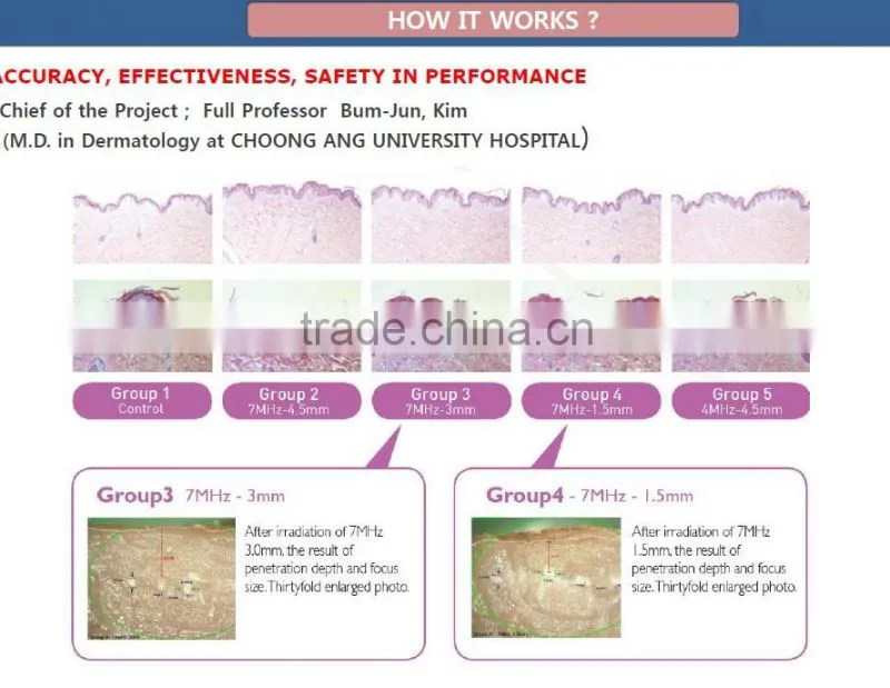 Portable and Manufactory Face Lift Device Ultrasound HIFU / HIFU EVERSUN face outline shrinkle effective HIFU Focused Liposix