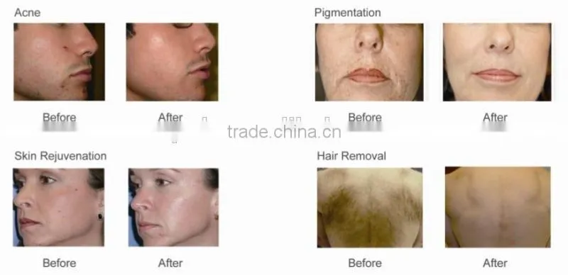 2015 hot sale IPL hair removal facial treatment for face- model HS-665