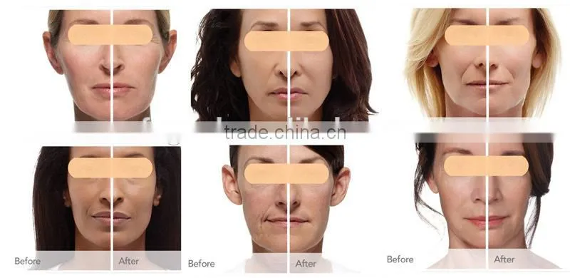Professional Co2 Fractional Laser Promotion Price Co2 Skin Resurfacing Medical Professional Co2